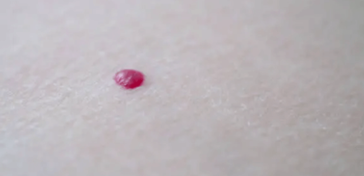 נקודות חן אדומות על העור